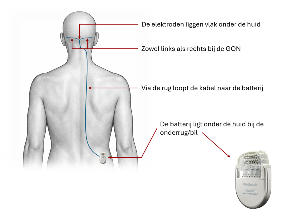 ONS plaatje draden en batterij
