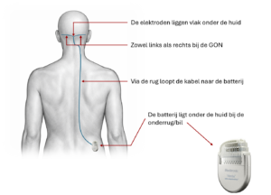 ONS plaatje draden en batterij
